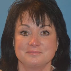 After Image: Facelift, Upper and Lower Eyelid Surgery by Dr. Henstrom - front