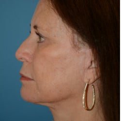 After Image