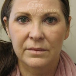 Before Image: Facelift | Fat Injections – 784 - front