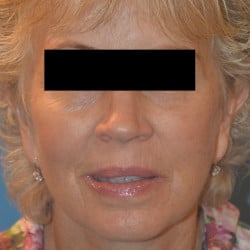After Image: Facelift, Browlift, Dermabrasion, Blepharoplasty, Dermabrasion and Chin Implant by Dr. Thompson - front