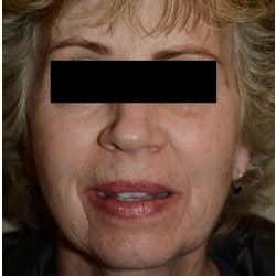 Before Image: Facelift, Browlift, Dermabrasion, Blepharoplasty, Dermabrasion and Chin Implant by Dr. Thompson - front