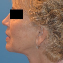 After Image: Facelift, Browlift, Dermabrasion, Blepharoplasty, Dermabrasion and Chin Implant by Dr. Thompson - left-side