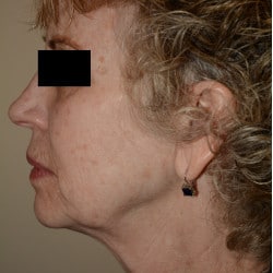 Before Image: Facelift, Browlift, Dermabrasion, Blepharoplasty, Dermabrasion and Chin Implant by Dr. Thompson - left-side