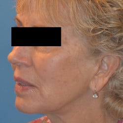 After Image: Facelift, Browlift, Dermabrasion, Blepharoplasty, Dermabrasion and Chin Implant by Dr. Thompson - left-front-oblique