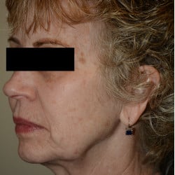 Before Image: Facelift, Browlift, Dermabrasion, Blepharoplasty, Dermabrasion and Chin Implant by Dr. Thompson - left-front-oblique