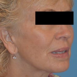 After Image: Facelift, Browlift, Dermabrasion, Blepharoplasty, Dermabrasion and Chin Implant by Dr. Thompson - right-front-oblique
