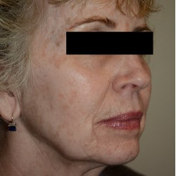 Before Image: Facelift, Browlift, Dermabrasion, Blepharoplasty, Dermabrasion and Chin Implant by Dr. Thompson - right-front-oblique