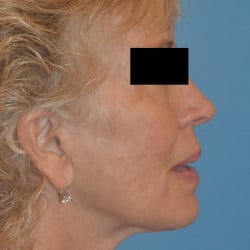 After Image: Facelift, Browlift, Dermabrasion, Blepharoplasty, Dermabrasion and Chin Implant by Dr. Thompson - right-side