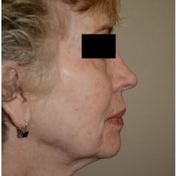 Before Image: Facelift, Browlift, Dermabrasion, Blepharoplasty, Dermabrasion and Chin Implant by Dr. Thompson - right-side