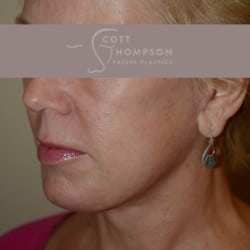 After Image: Facelift | Fat Injections – 361 - left-front-oblique