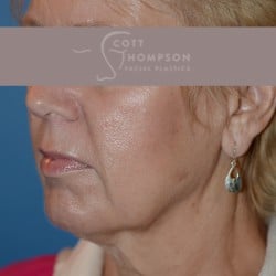 Before Image: Facelift | Fat Injections – 361 - left-front-oblique