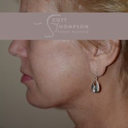 After Image: Facelift | Fat Injections – 361 - left-side