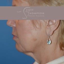 Before Image: Facelift | Fat Injections – 361 - left-side