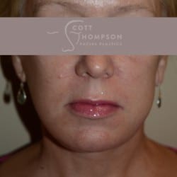 After Image: Facelift | Fat Injections – 361 - left-front-oblique