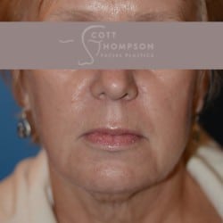 Before Image: Facelift | Fat Injections – 361 - left-front-oblique