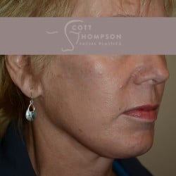 After Image: Facelift | Fat Injections – 361 - right-front-oblique