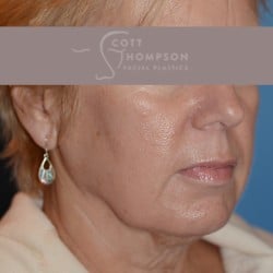 Before Image: Facelift | Fat Injections – 361 - right-front-oblique