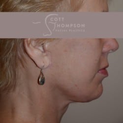 After Image: Facelift | Fat Injections – 361 - right-side