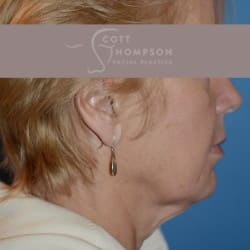 Before Image: Facelift | Fat Injections – 361 - right-side
