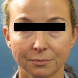 Before Image: Fat Transfer and Laser Resurfacing by Dr. Thompson - front