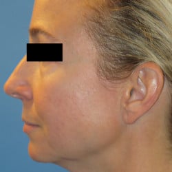 Before Image: Fat Transfer and Laser Resurfacing by Dr. Thompson - left-side