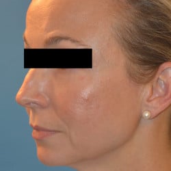 After Image: Fat Transfer and Laser Resurfacing by Dr. Thompson - left-front-oblique