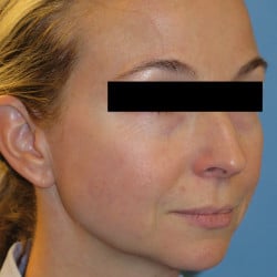 Before Image: Fat Transfer and Laser Resurfacing by Dr. Thompson - right-front-oblique