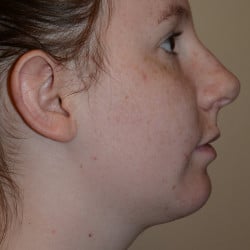 After Image: Chin Augmentation by Dr. Thompson - right-side