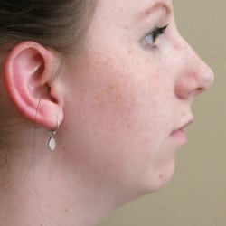 Before Image: Chin Augmentation by Dr. Thompson - right-side