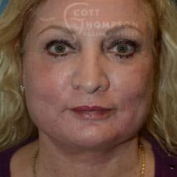 After Image: Facelift, Lower Blepharoplasty, Dermabrasion, and Fat Injections by Dr. Thompson - front