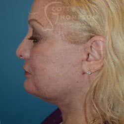 After Image: Facelift, Lower Blepharoplasty, Dermabrasion, and Fat Injections by Dr. Thompson - left-side