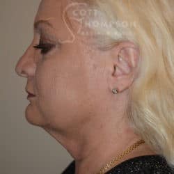 Before Image: Facelift, Lower Blepharoplasty, Dermabrasion, and Fat Injections by Dr. Thompson - left-side