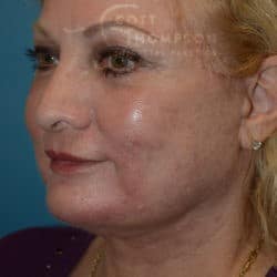 After Image: Facelift, Lower Blepharoplasty, Dermabrasion, and Fat Injections by Dr. Thompson - left-front-oblique