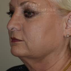 Before Image: Facelift, Lower Blepharoplasty, Dermabrasion, and Fat Injections by Dr. Thompson - left-front-oblique