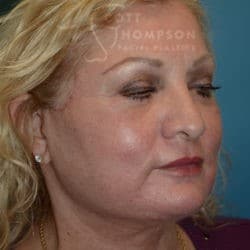 After Image: Facelift, Lower Blepharoplasty, Dermabrasion, and Fat Injections by Dr. Thompson - right-front-oblique
