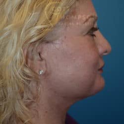After Image: Facelift, Lower Blepharoplasty, Dermabrasion, and Fat Injections by Dr. Thompson - right-side