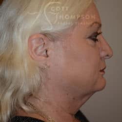 Before Image: Facelift, Lower Blepharoplasty, Dermabrasion, and Fat Injections by Dr. Thompson - right-side