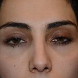 After Image: Peri-Orbital Fat Injections – 909 - front