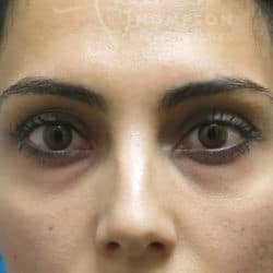 Before Image: Peri-Orbital Fat Injections – 909 - front