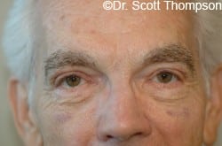 After Image: Upper Blepharoplasty by Dr. Thompson - front