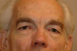 Before Image: Upper Blepharoplasty by Dr. Thompson - front