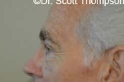 After Image: Upper Blepharoplasty by Dr. Thompson - left-side
