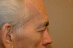 After Image: Upper Blepharoplasty by Dr. Thompson - right-side