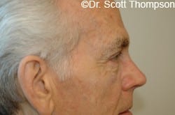 Before Image: Upper Blepharoplasty by Dr. Thompson - right-side