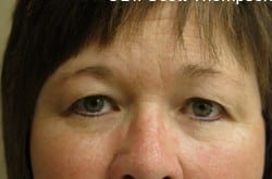 After Image: Upper Blepharoplasty by Dr. Thompson - front