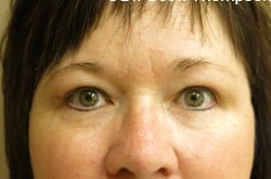 Before Image: Upper Blepharoplasty by Dr. Thompson - front