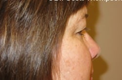 After Image: Upper Blepharoplasty by Dr. Thompson - right-side