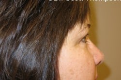 Before Image: Upper Blepharoplasty by Dr. Thompson - right-side