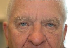 After Image: Upper Blepharoplasty by Dr. Thompson - front