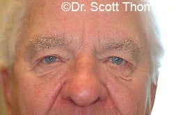 Before Image: Upper Blepharoplasty by Dr. Thompson - front